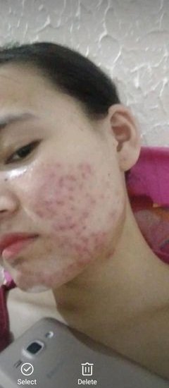 Acne Situation Before Starting KBeauty Routine